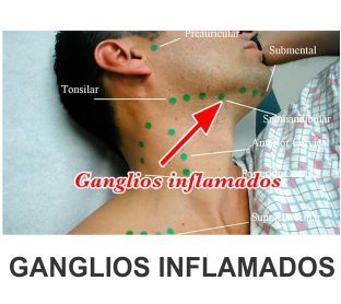 GANGLIO INFLAMADOS