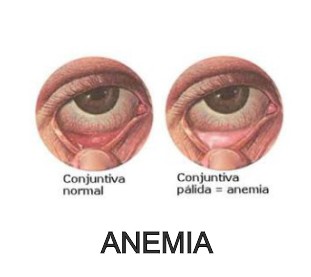 anemia moringapura dorada