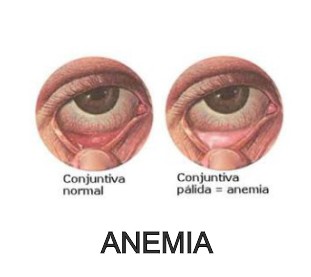 anemia moringapura dorada