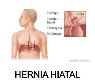 hernia hiatal lm