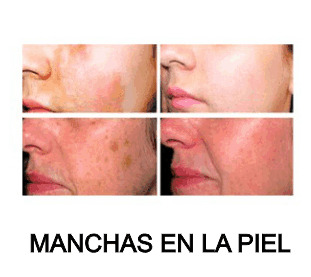 manchas en la piel lm