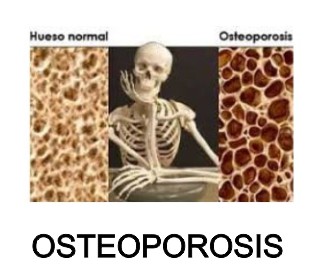 osteoporosis moringapura oroverde