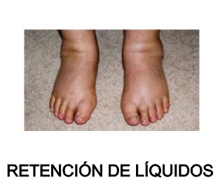 retencion de liquidos  riones kidney