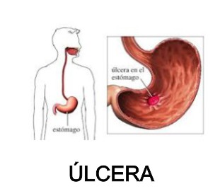 ulcera duodenal lm ulcer ulcera gastrica fibramor ulcer