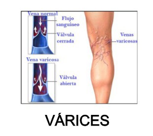 varices moringapura perlas